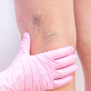 Redukuje opuchliznę